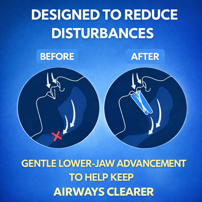 NightSide® Snoring Mouth Guard